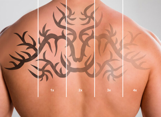 Laser Tattoo Removal – Bodilight Beauty Clinic Milton Keynes